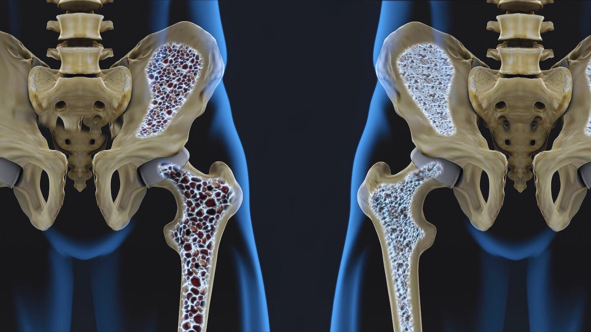 Osteoporosis