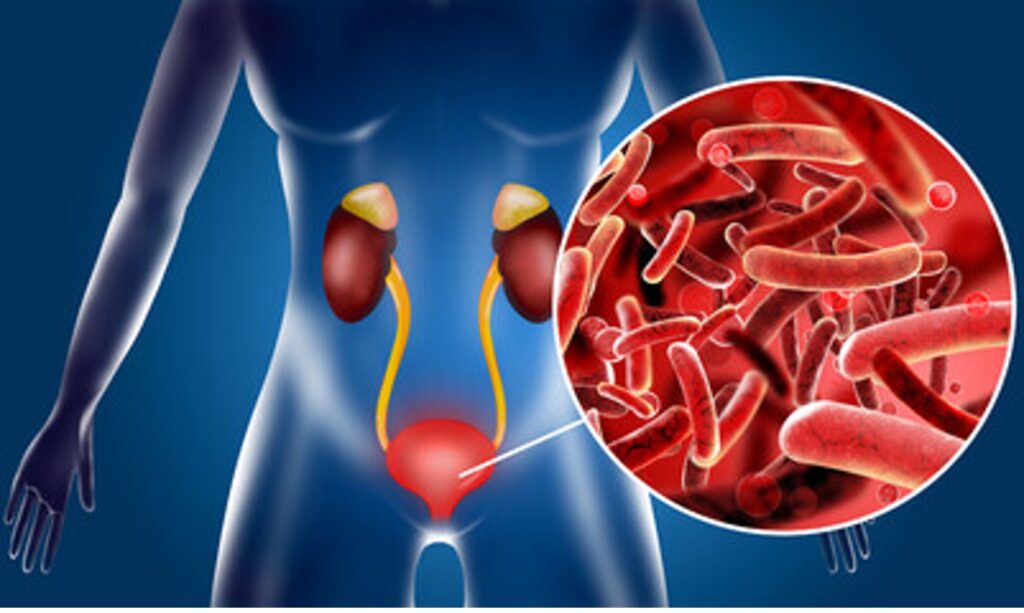 Urinary Tract Infections